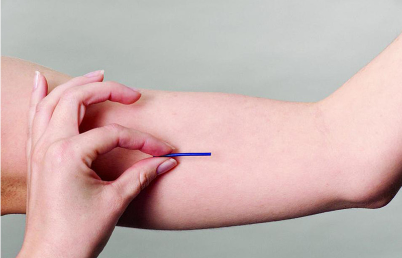 Chip Hormonal – O que é, Como Funciona e Quais São os Benefícios